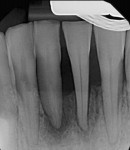 Case 2 post-treatment radiograph showing 3-mm probing depths circumferentially at 7-month follow-up.