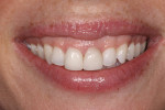 The patient was unhappy with the appearance of her existing veneers on teeth Nos. 8 and 9.