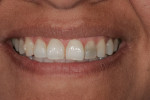 Post-orthodontic treatment full smile. Note the improved alignment.