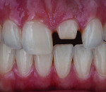 Fig 2 and Fig 3. It is merely a matter of a matching the color, value, texture, and form to surrounding natural dentition.