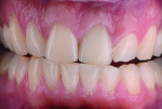Fig 12. Once the crown was cemented in place, it was easy to see that the driving variable in the success of this case treatment was the recontouring of the gingiva to allow for adequate form of the tooth being restored.