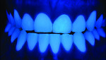 Fig 27. The final veneer can be checked under fluorescent light to observe that the restoration exhibits the same fluorescent properties as the surrounding natural dentition.