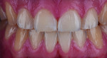 Fig 28. The underlying tooth color helped the restorative team achieve a successful outcome with minimal removal of natural dentition.