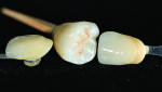 Fig 28. View of the completed IPS e.max Press Multi monolithic crown restoration after staining and glazing.