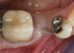 Figure 16 Mandibular second premolar implant with no KM on buccal.