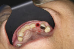 Figure 23 Closure of palatal incision.