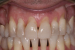 Figure 1 Clinical view of teeth Nos. 6 through 11 exhibiting Miller Class III gingival recession defects prior to treatment.