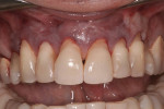 Figure 2 Intrasulcular incisions were made and a mucogingival tunnel created, protecting the
interdental papilla.