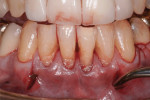 Figure 7 Using the modified tunnel technique, a mucogingival tunnel was made, protecting the
interdental papilla.