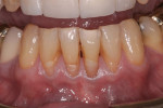 Figure 6 Clinical view of teeth Nos. 23 through 26 exhibiting Miller Class III gingival recession defects prior to treatment.