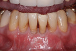Figure 10. After approximately 12 weeks, all sites were found to have healed well, with improved gingival thickness, root coverage, and little to no change in papillary height.
