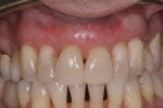 Figure 5 After approximately 12 weeks, all sites were found to have healed well, with improved gingival thickness, root coverage, and little to no
change in papillary height.