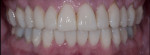 Figure 3 Direct BFEPs were created using a clear matrix technique and high-filler flowable composite.