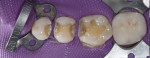 Figure 6 Occlusal views of the initial situation, upper left quadrant, showing the BFEP, prototype removal, amalgam removal, caries detection, dentin seal/blocked undercuts, and final restorations.
