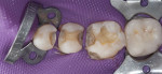 Figure 5 Occlusal views of the initial situation, upper left quadrant, showing the BFEP, prototype removal, amalgam removal, caries detection, dentin seal/blocked undercuts, and final restorations.