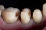 Figure 8 Views of the tooth preparation prior to impression-taking.