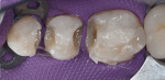 Figure 7 Occlusal views of the initial situation, upper left quadrant, showing the BFEP, prototype removal, amalgam removal, caries detection, dentin seal/blocked undercuts, and final restorations.
