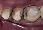 Figure 9 Views of the tooth preparation prior to impression-taking.