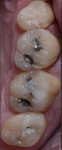 Figure 17 A summary of the clinical procedures: the preoperative condition, the BFEPs, removal of the prototypes, defective amalgam restorations, placement of caries detector, sealing the dentin and blocking undercuts, and placement of the final restorations.