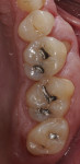 Figure 15 A summary of the clinical procedures: the preoperative condition, the BFEPs, removal of the prototypes, defective amalgam restorations, placement of caries detector, sealing the dentin and blocking undercuts, and placement of the final restorations.