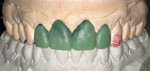 Figure 4  A wax-up of the desired form of the maxillary incisors was created.