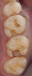 Figure 19 A summary of the clinical procedures: the preoperative condition, the BFEPs, removal of the prototypes, defective amalgam restorations, placement of caries detector, sealing the dentin and blocking undercuts, and placement of the final restorations.