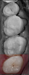 Figure 22 Cementation was performed from the most distal to the anterior.