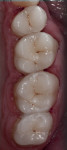 Figure 25 Cementation was performed from the most distal to the anterior.