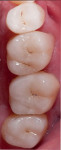 Figure 26 Postoperative occlusal view (can be compared to preoperative view in Fig 15).