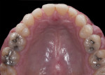 Figure 28 Preoperative and postoperative
occlusal views of the maxillary arch.