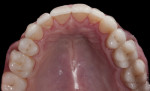 Figure 29 Preoperative and postoperative
occlusal views of the maxillary arch.
