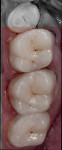 Figure 24 Cementation was performed from the most distal to the anterior.