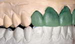 Figure 5  Using the wax-up, care was taken to maintain occlusal harmony in all excursive pathways.