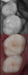 Figure 23 Cementation was performed from the most distal to the anterior.