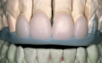 Figure 7  Silicone putty was used to create an incisal matrix.