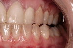 Figure 11  Right lateral view of the patient following occlusal adjustments.