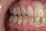 Figure 12  Left lateral view of the patient following occlusal adjustments.