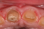 Figure 13  View of the gingival in-growth that occurred over the preparation margins during the 2-week provisionalization period.