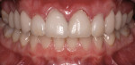Figure 16  View of the maxillary CAD/CAM crown and veneer restorations following placement.