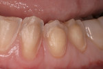 Figure 17  The teeth were prepared in such a manner as to provide adequate ceramic thickness in the occlusal regions.