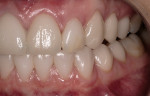 Figure 18  Left lateral postoperative view demonstrating that the patient had been restored to occlusal harmony throughout the envelope of function.