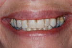 Figure 5 Gingival levels exposed with a normal smile.