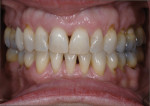 Figure 7 Tooth alignment after completed orthodontic treatment.