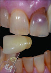Fig 1 and Fig 2. A veneer preparation had an undesirable abutment color due to previous trauma to the tooth.