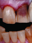 Fig 1 and Fig 2. A veneer preparation had an undesirable abutment color due to previous trauma to the tooth.