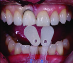 Fig 11 to Fig 13. A patient presented with a chipped incisal edge.