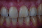 Fig 7. A patient had a chip to the incisal edge of tooth No. 9 with a slight but distracting discoloration.