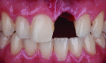 Fig 16. A patient lost tooth No. 9 from trauma and the mesial incisal edge of tooth No. 8 was damaged.