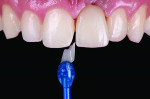 Fig 19. The screw-retained restoration is seen in situ and the additive chip is being seated to restore the mesial fracture.