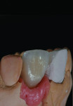 Fig 17 and Fig 18. The author fabricated a screw-retained restoration for the implant-restored site and a ceramic chip to be added to the mesial incisal fracture.